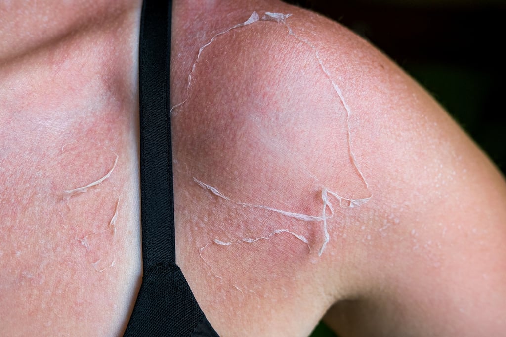 Young woman showing her shoulders and neck with sunburn in summer. The skin flakes off or peels off after sun. Concept of UV protection while tanning on the beach. Application of spf and uv